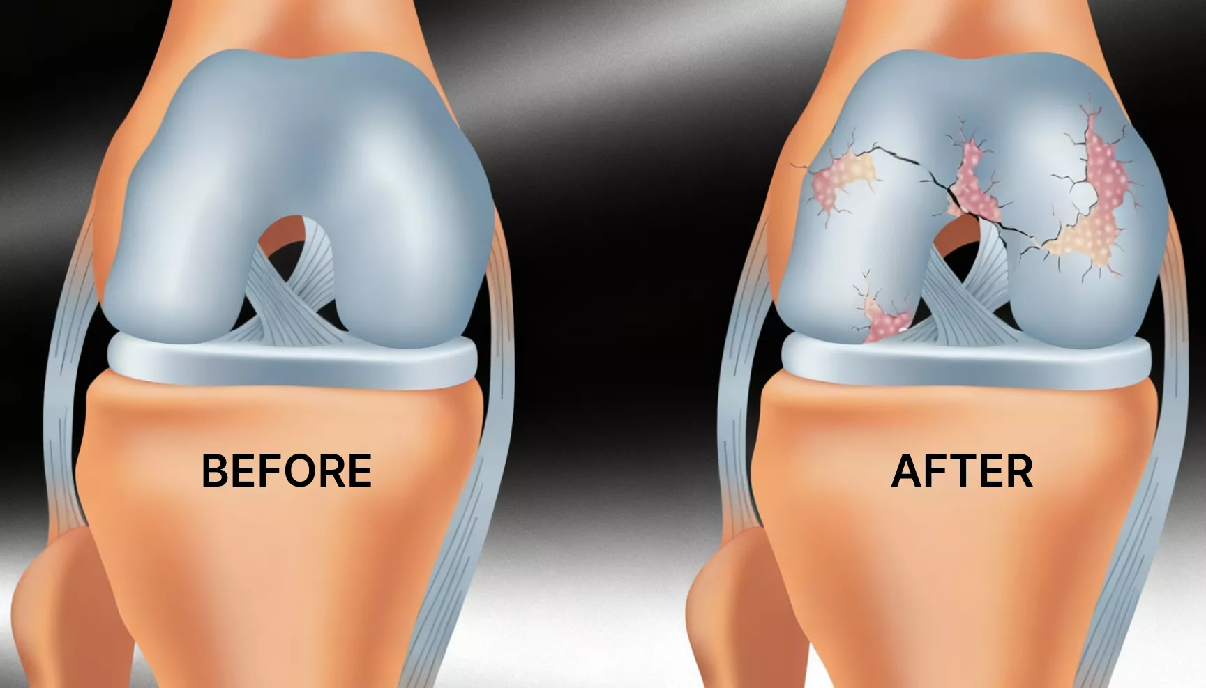Patient experiencing knee osteoarthritis pain