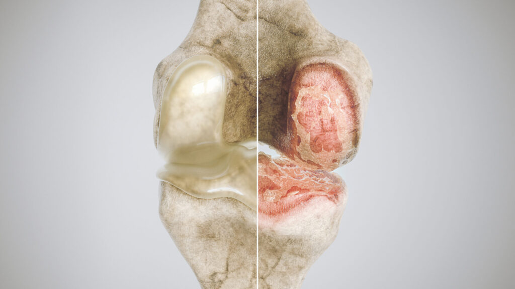 normal knee vs knee osteoarthritis